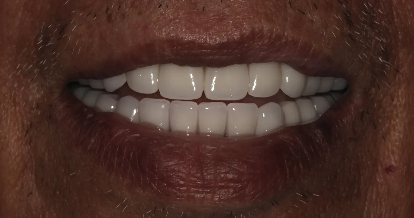 Full-mouth restoration with a denture and implants: after