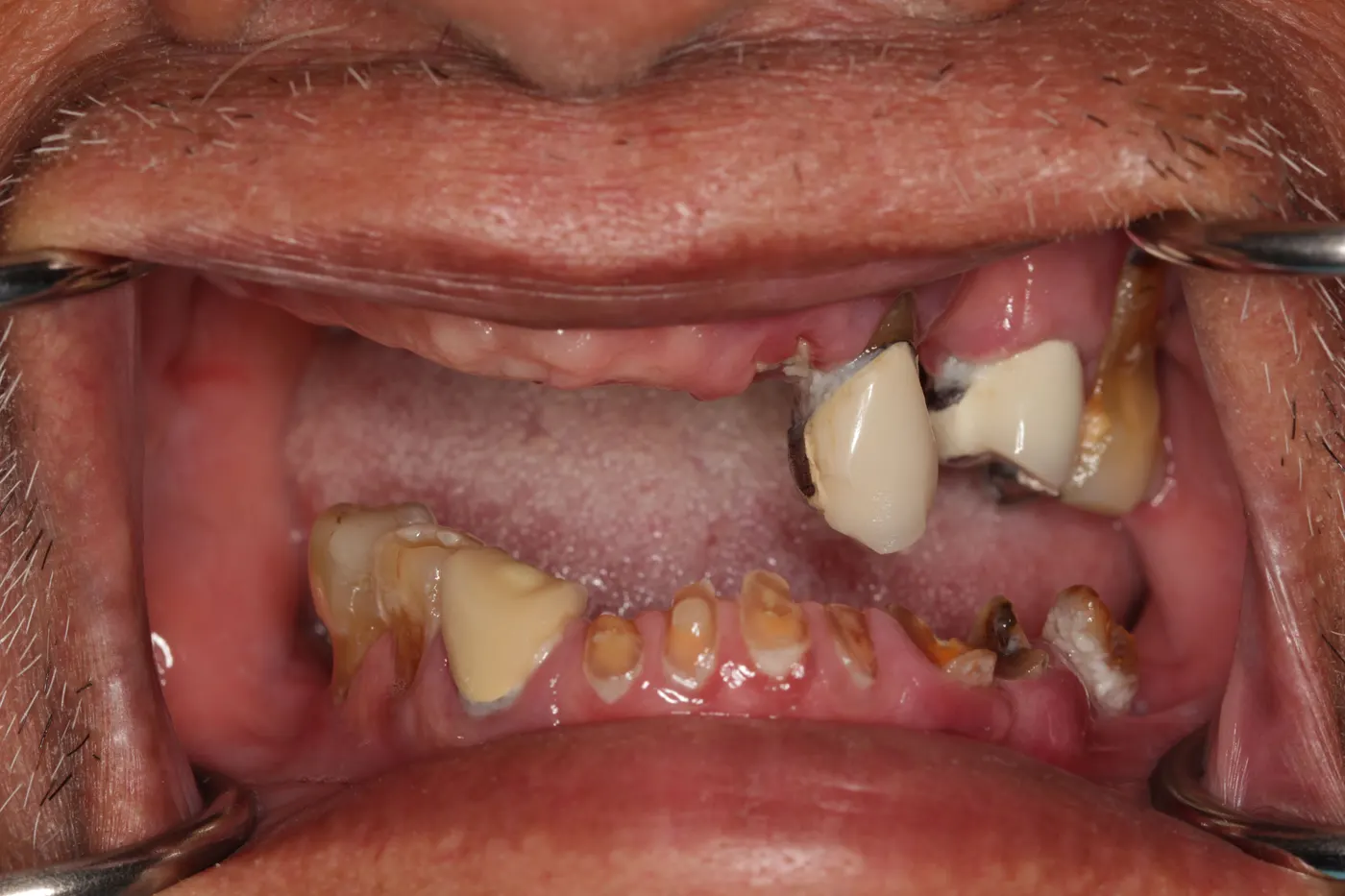Full-mouth restoration with a denture and implants: before