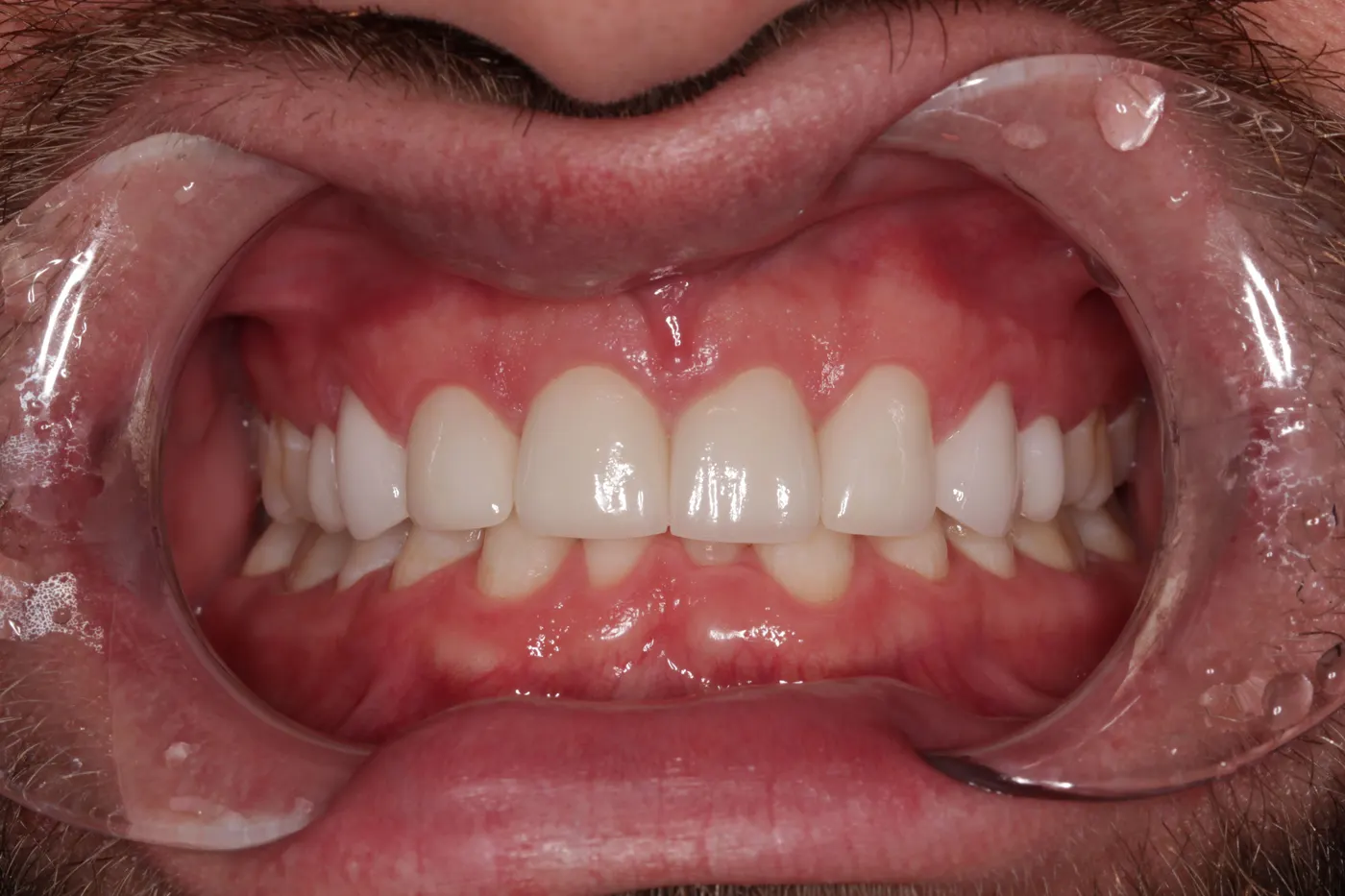 Smile redesign with crowns and veneers: after