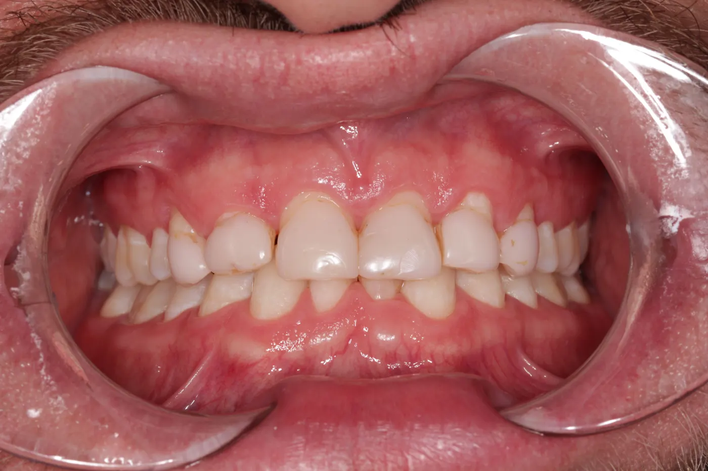 Smile redesign with crowns and veneers: before