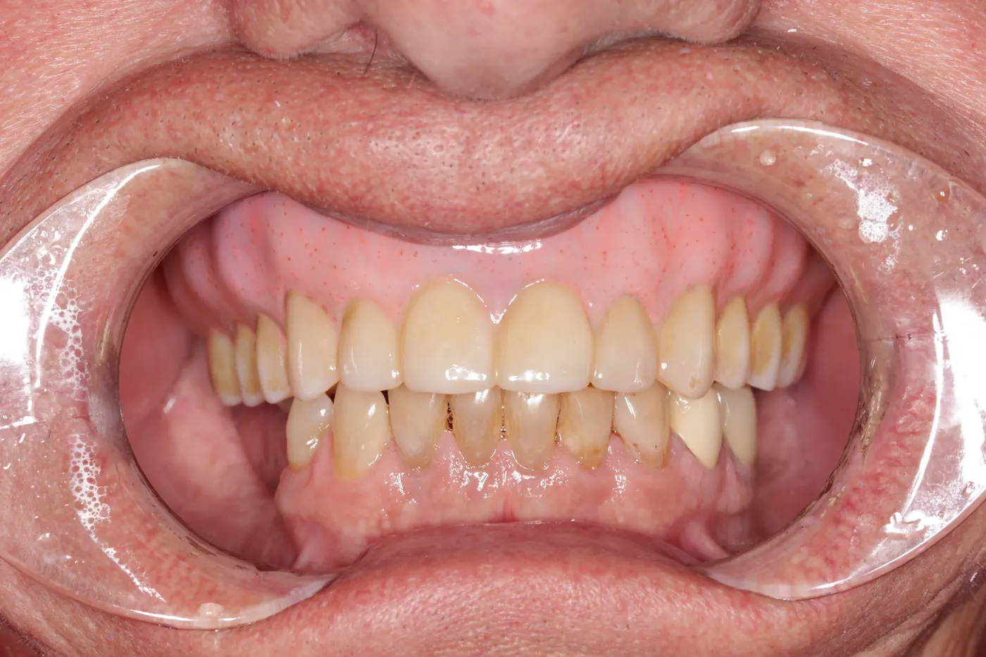 Upper denture: after