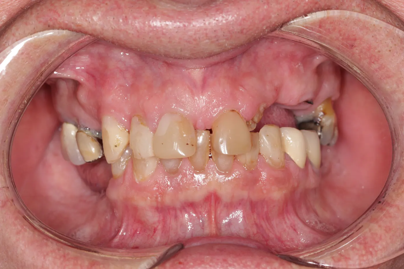 Upper denture: before