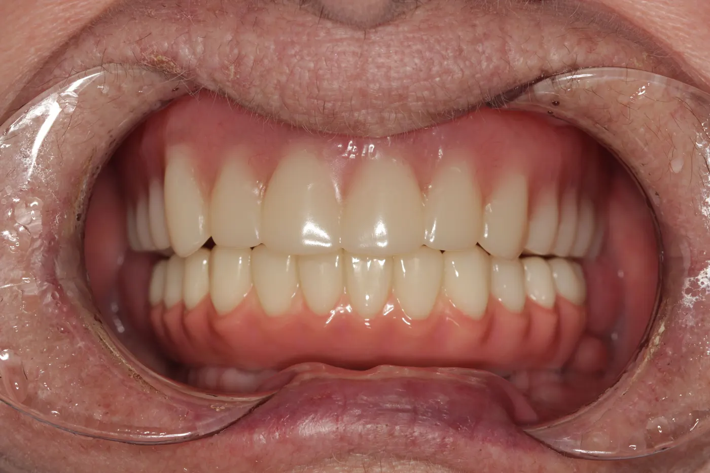 Full-mouth restoration with an upper denture and a lower implant bridge: after
