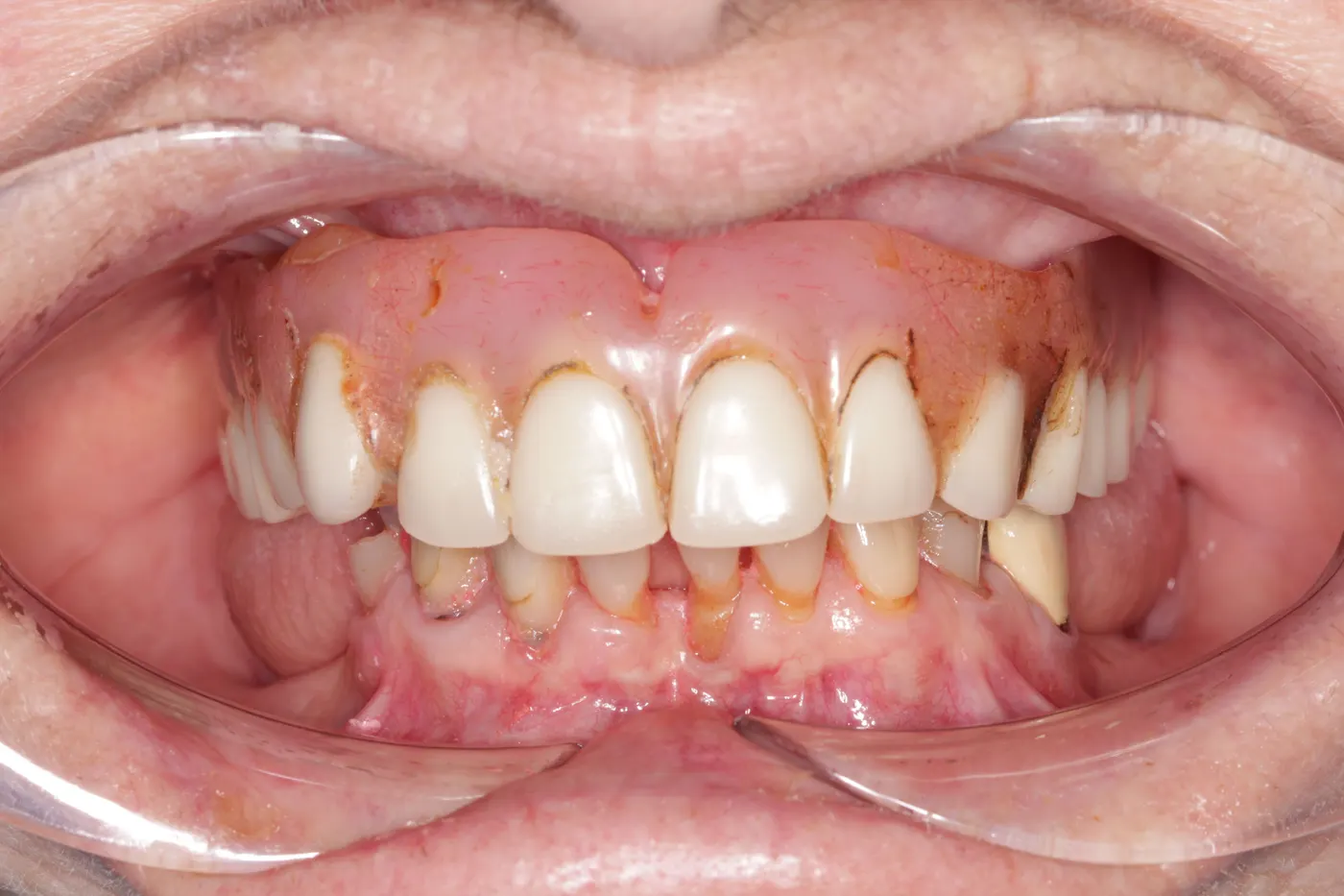 Full-mouth restoration with an upper denture and a lower implant bridge: before