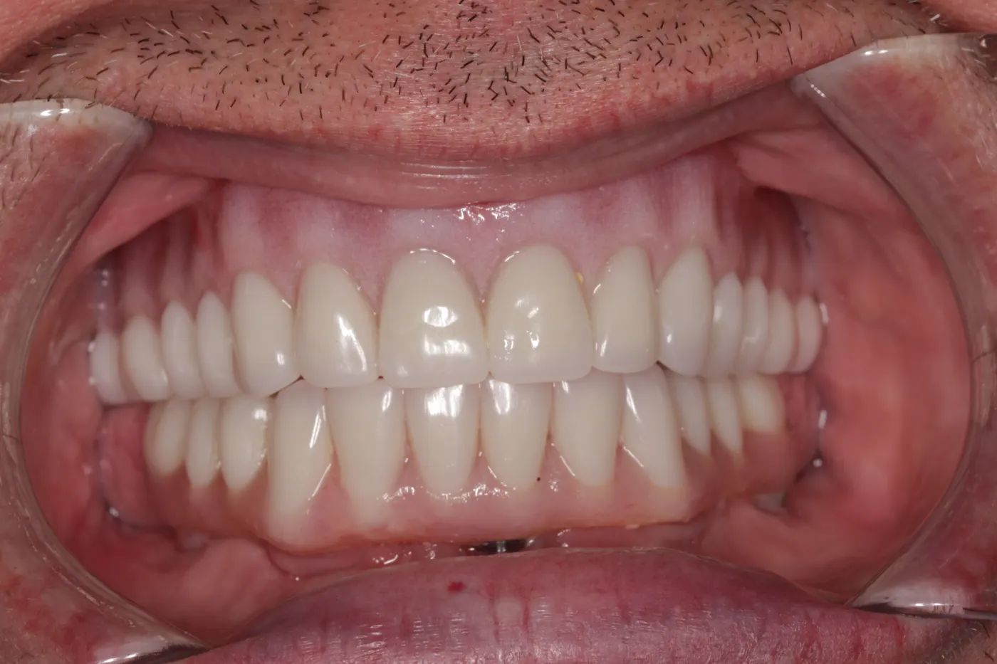 Full-mouth restoration: after