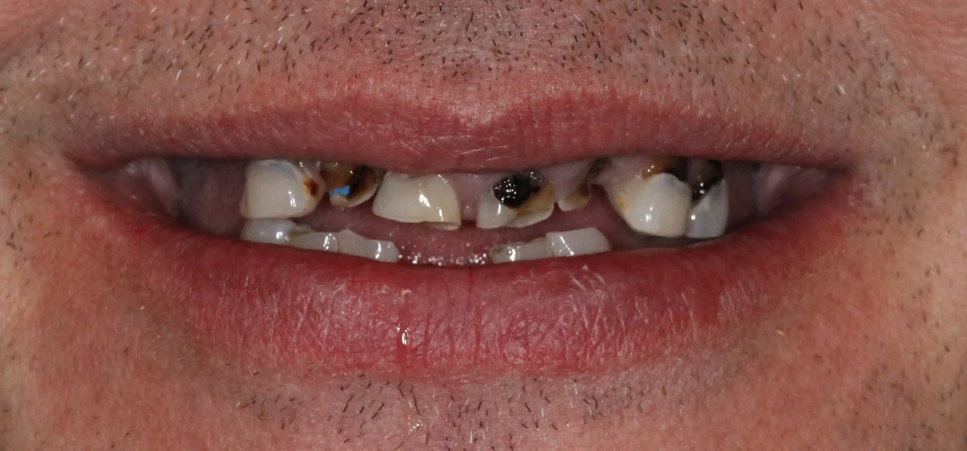 Full-mouth restoration: before