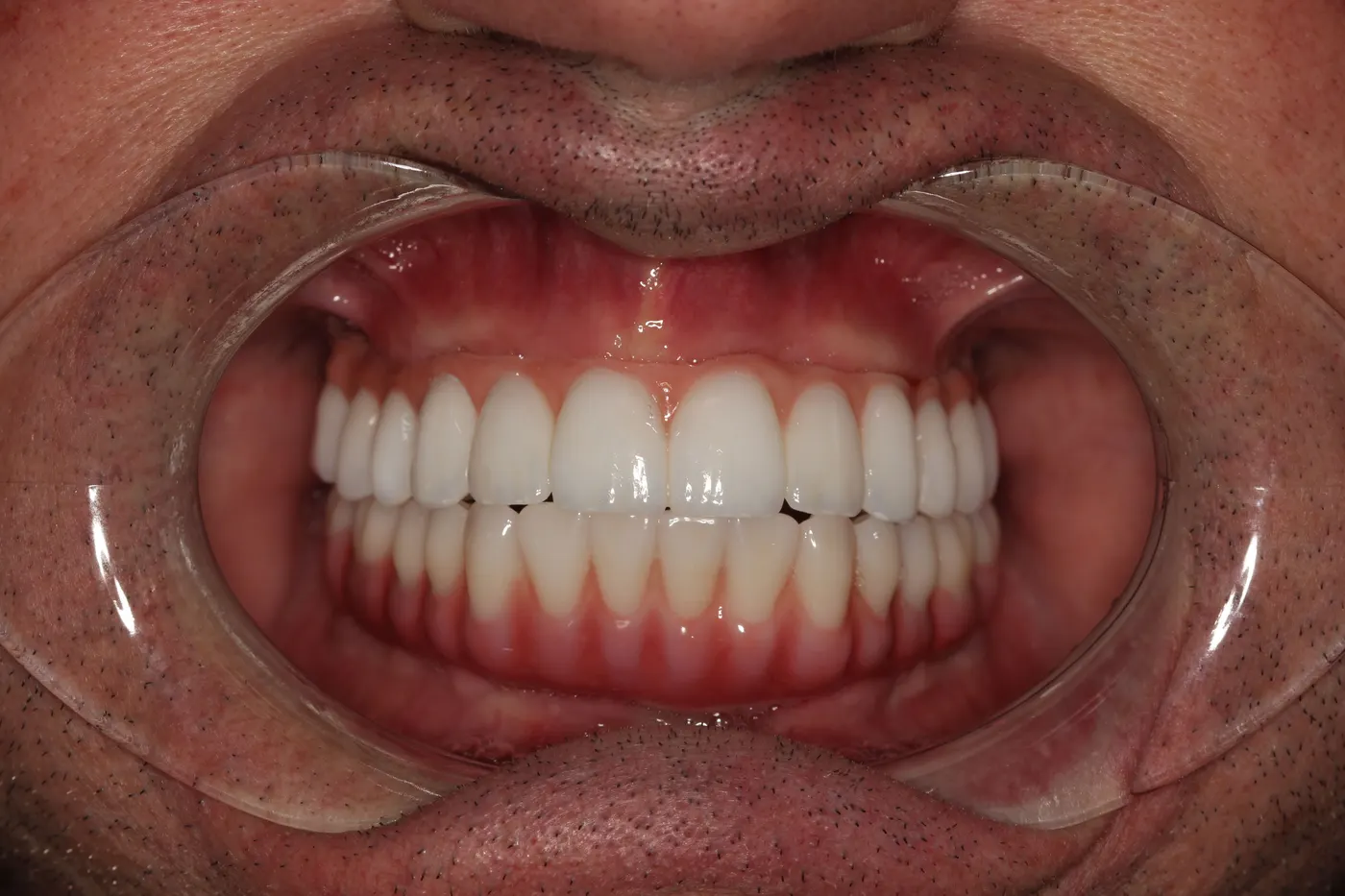 Full-mouth restoration: after