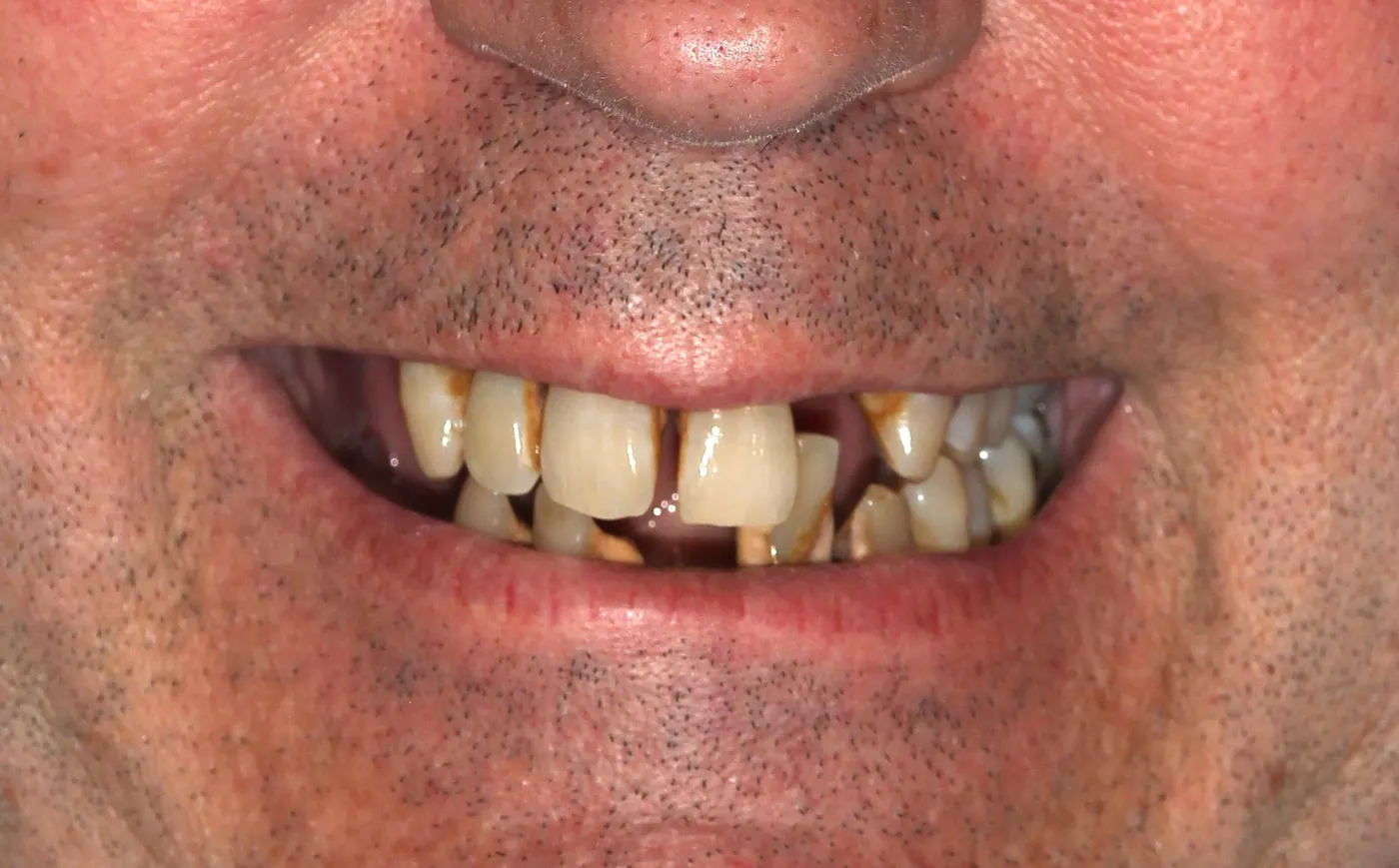 Full-mouth restoration: before