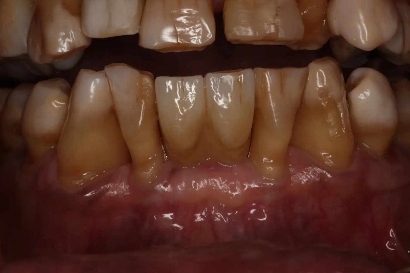 Lower front implant: after