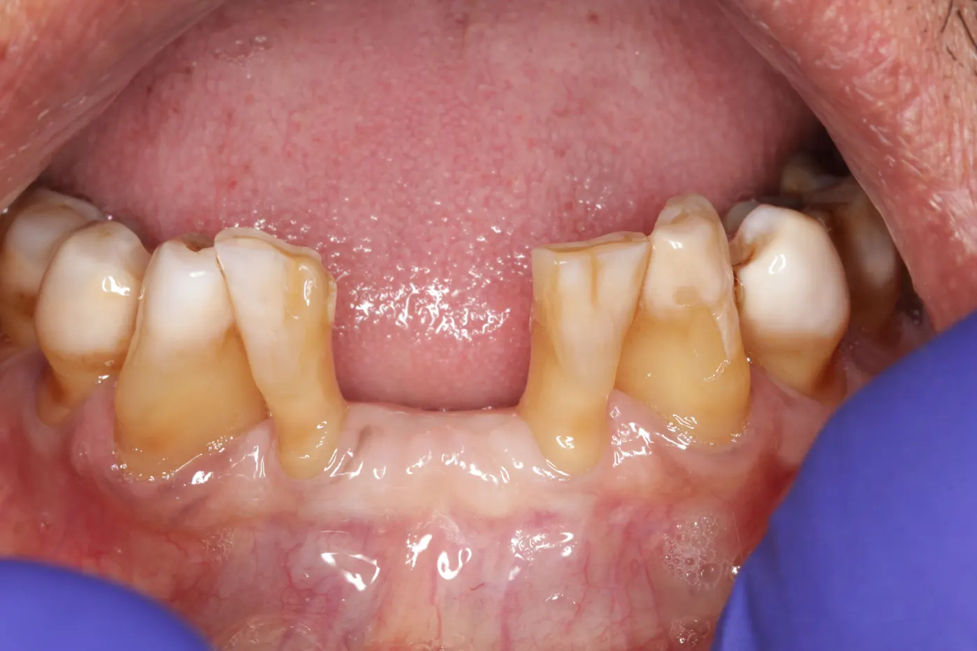 Lower front implant: before