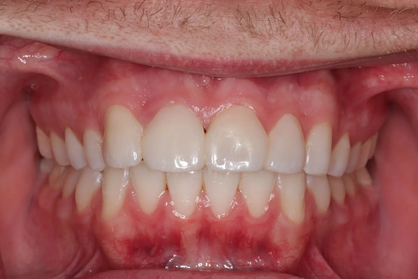 Crowns and veneers: after