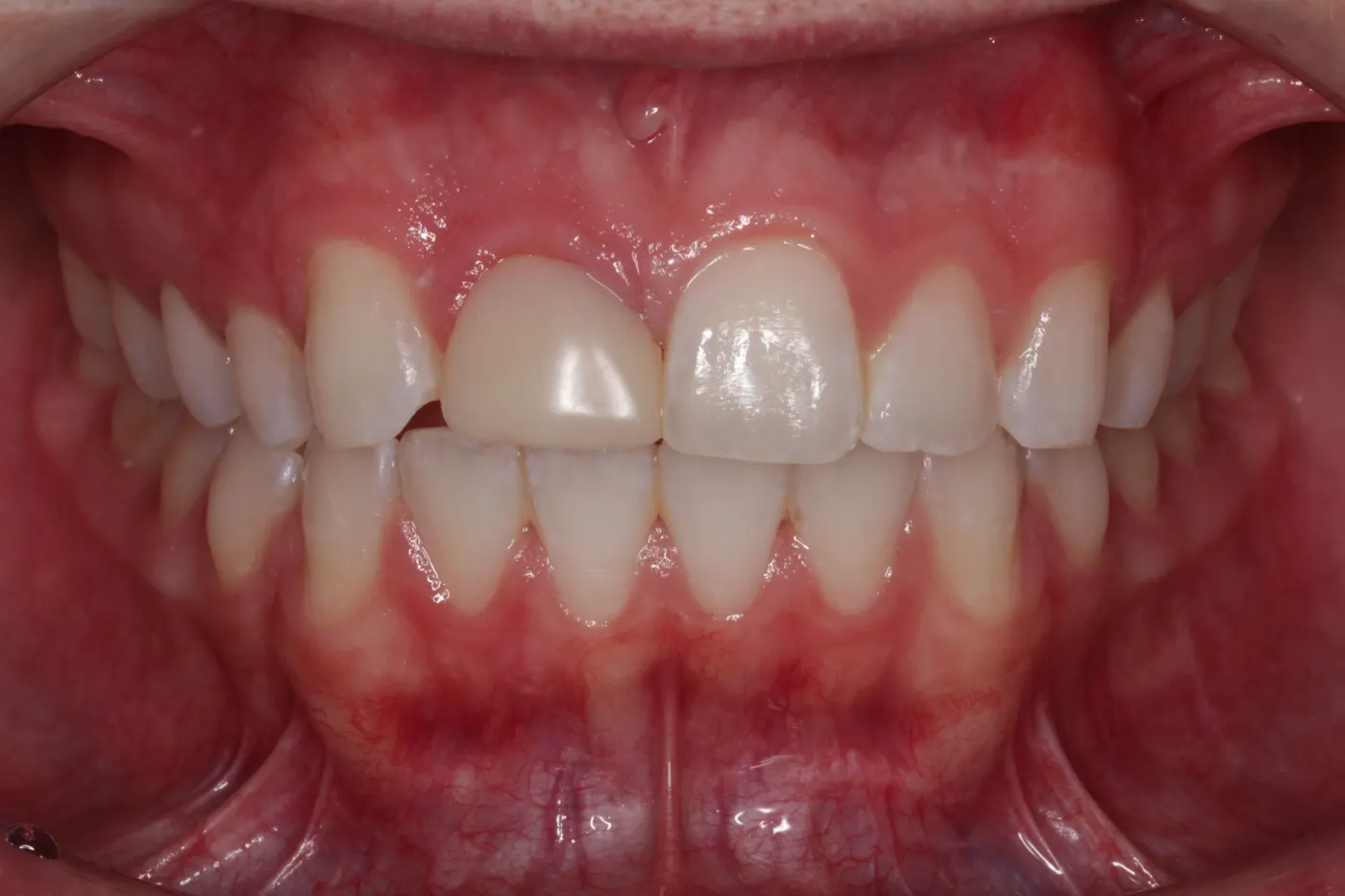 Crowns and veneers: before