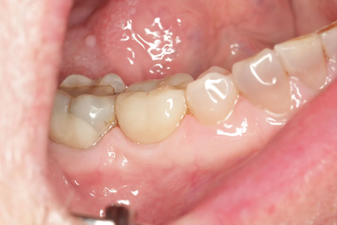 Single lower implant: after