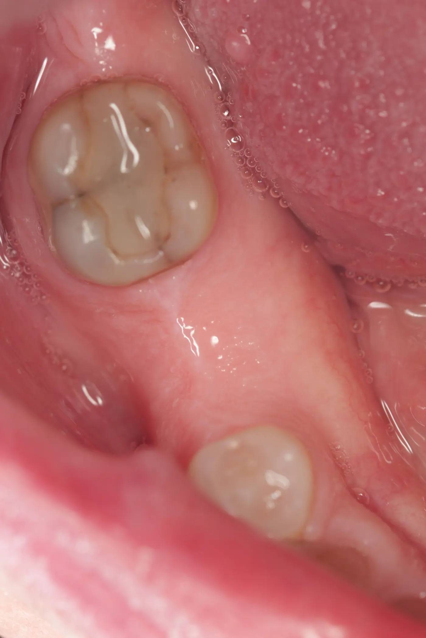 Single lower implant: before