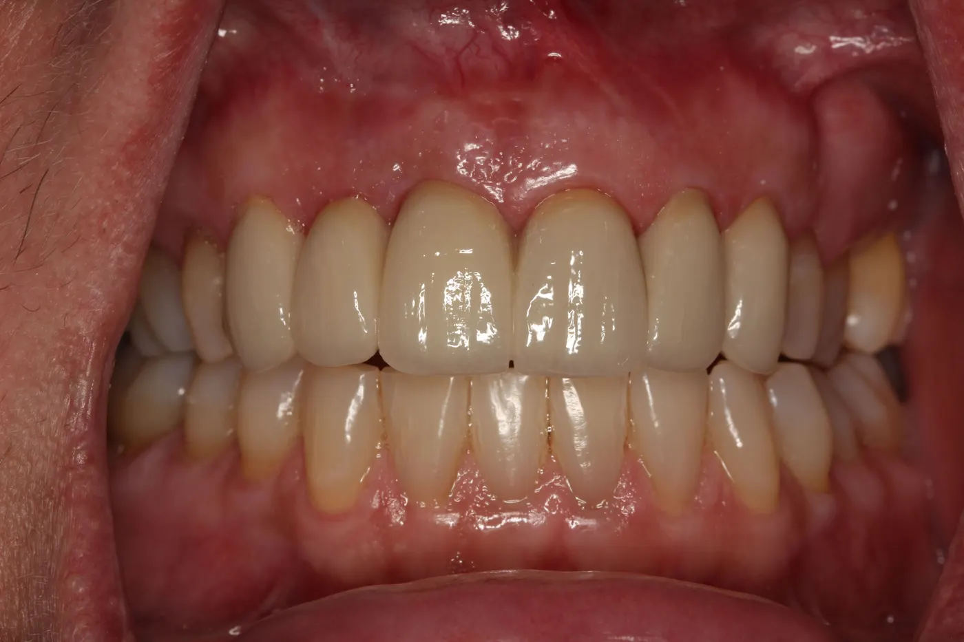 Upper smile redesign with crowns and bridges: after