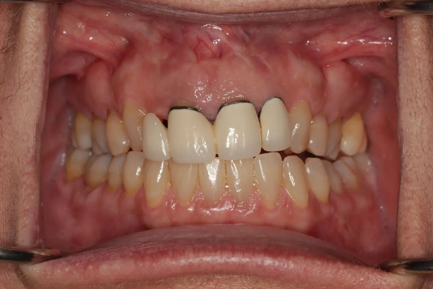 Upper smile redesign with crowns and bridges: before