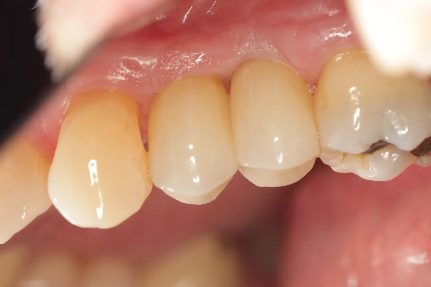 Dental implants for missing upper left teeth: after