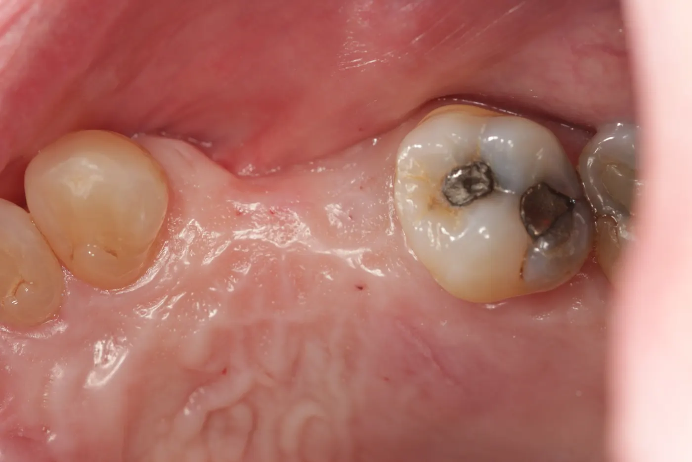 Dental implants for missing upper left teeth: before