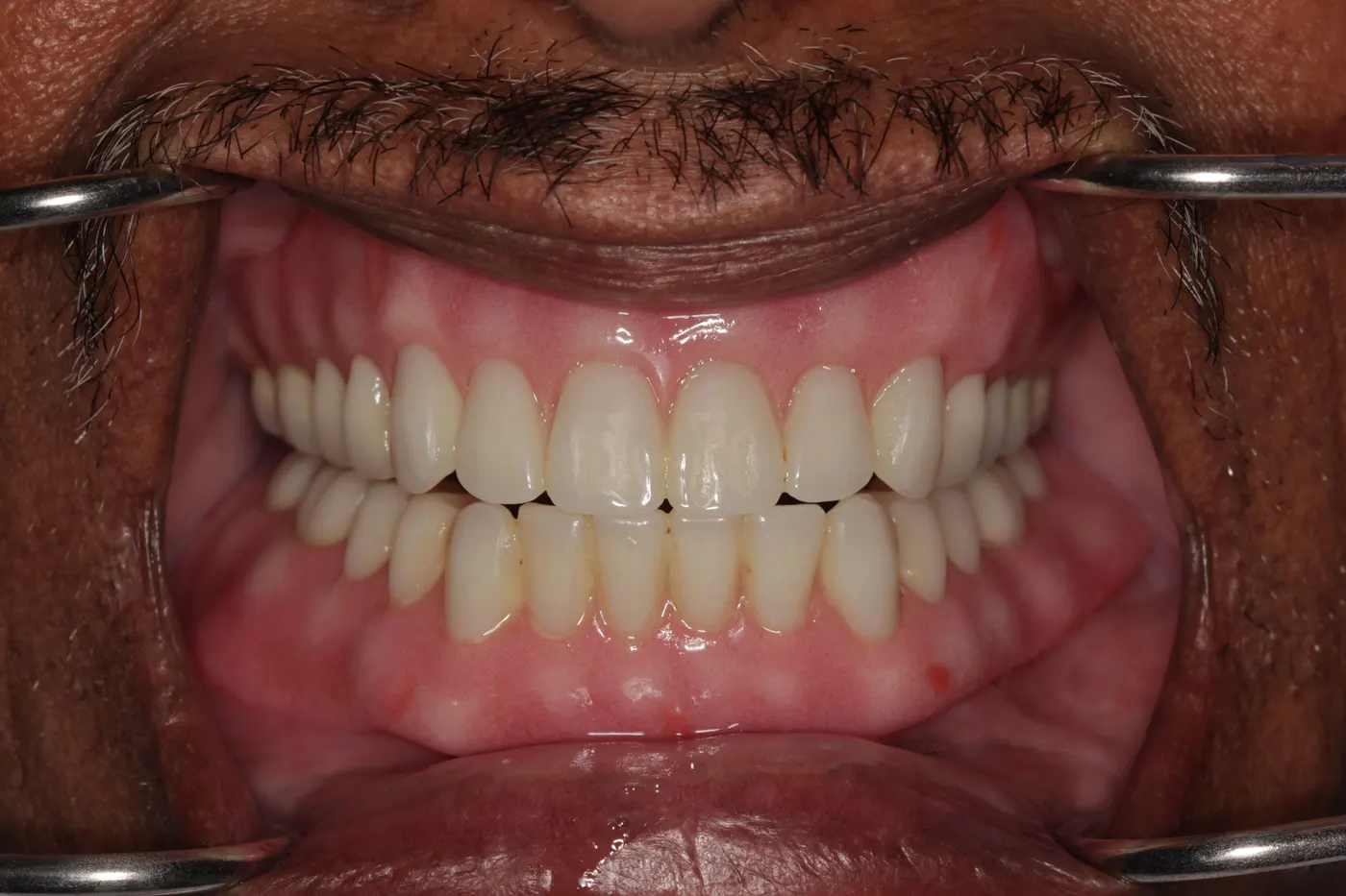 Full-mouth restoration: after