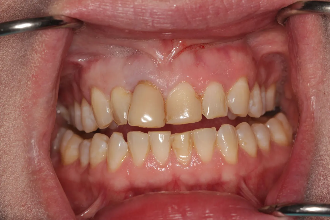 Upper front smile redesign with a bridge and crowns: before