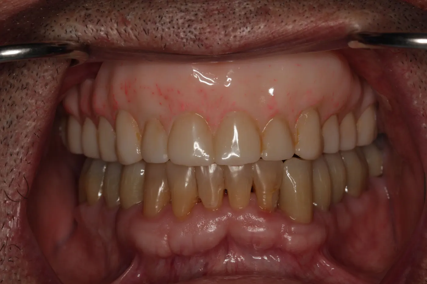 Full-mouth restoration with an upper denture, lower crowns, and composite fillings: after