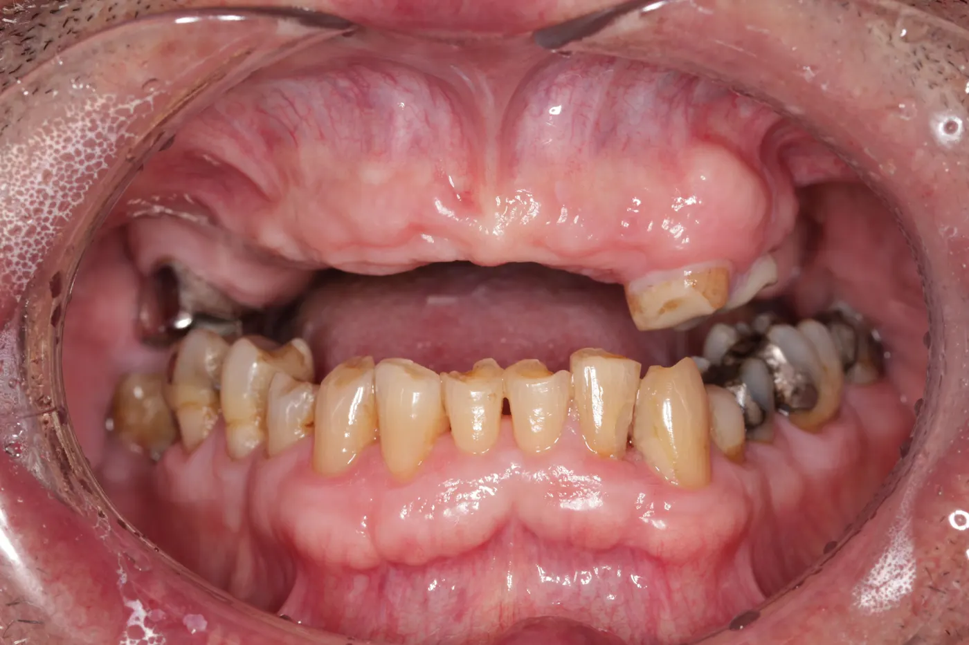 Full-mouth restoration with an upper denture, lower crowns, and composite fillings: before