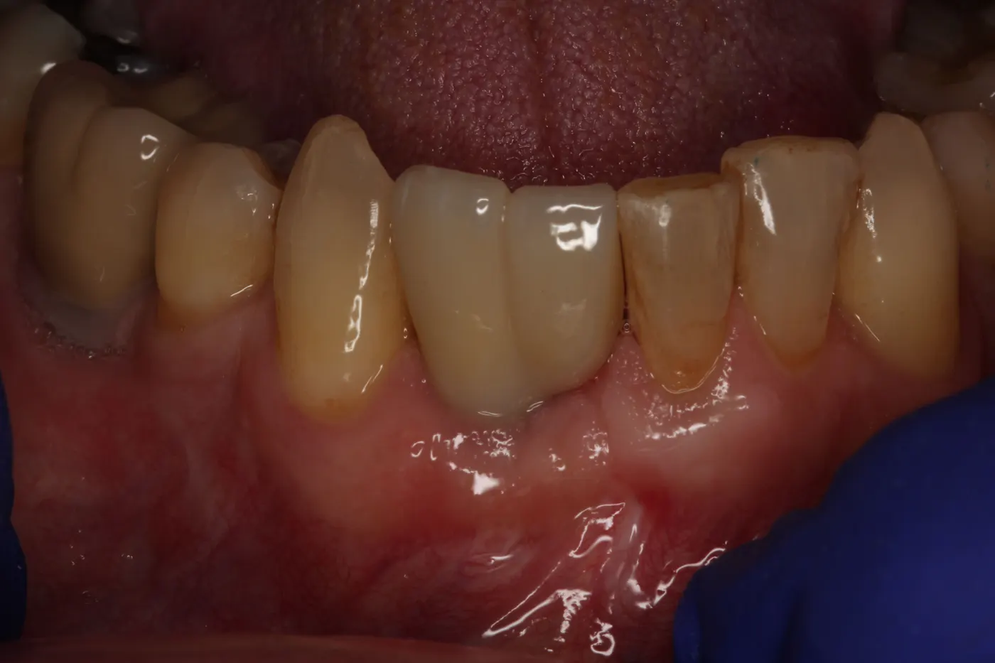 Lower front implant: after