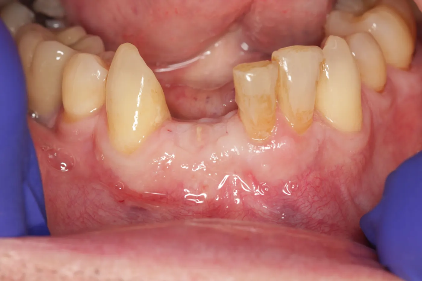 Lower front implant: before