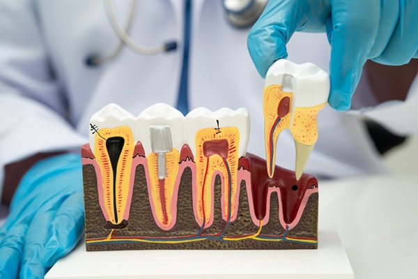 Signs Of A Failed Root Canal